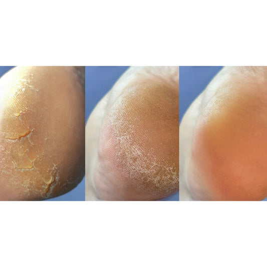NAILSOFTHEDAY Anti-Crack Cream — cream for cracked skin on hands and feet, with 12% urea, 30 ml.